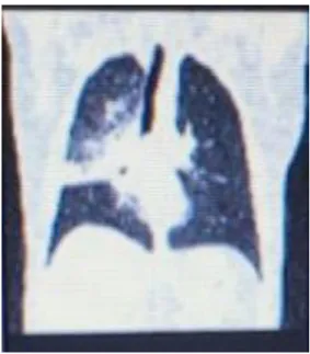 Figura 3-2: TAC de Tórax Contrastada 