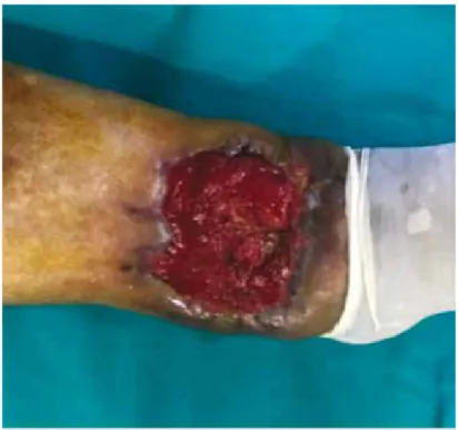 Figura 2. Estado de ulcera de pierna  izquierda a su egreso de terapia  intensiva