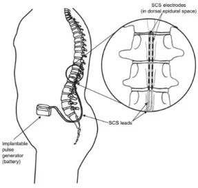 Figure 1. Schematic of implanted Spinal Cord Stimulation   (Raphael et al, 2009). With permission