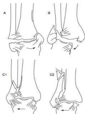 Figura 1:  Clasificación de Danis-Weber de las fracturas  de  tobillo según  el  mecanismo  de  la  lesión,  el aspecto  y  localización de la fractura del peroné (v