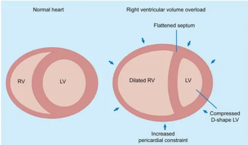Figure 2. Ventricular interdependence in right ventricular failure. Dilatation of the right ventricle shifts the interventricular septum  toward  the  left,  changing  left  ventricular  geometry