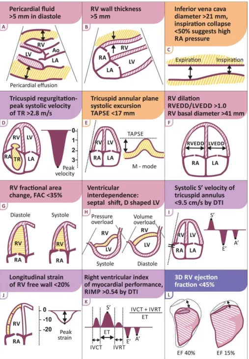 Figure  3.  Graphic  representation  of  echocardiographic  parameters  in  the  assessment  of  right  ventricular  failure