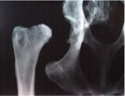 Figure 11. Radiograph of the innominate: great new bone formation in the innominate, and bone resorption in the femur head.