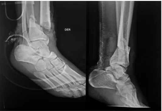 Ilustración 8-2: Radiografía Oblicua y Lateral de pierna derecha. 