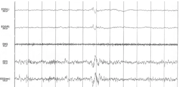 Figure 2.11. Example of N2 sleep state. Background EEG similar to N1 with presence of K-complexes  (center) and sleep spindles (first third of the epoch)