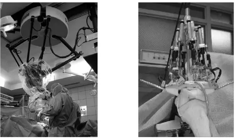 Figura 13. A la izquierda, es el ISIS / SurgiScope sistema utilizando un robot Delta como soporte  de microscopio (aquí en el hospital Val de Grace de París, ISIS)
