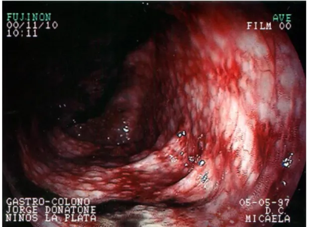 Figura 3.  Vasculitis alérgica a la rectosigmoidoscopia