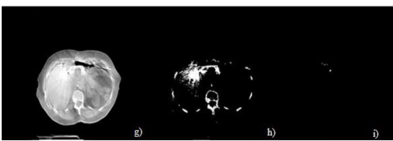 Fig.  3.1  g)  Imagen  original.  h)  Segmentación  de  artefactos  usando  Kitler  86