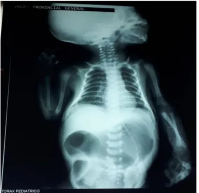 Ilustración 3-2: Radiografía simple de abdomen. 19/10/2019. 23:51