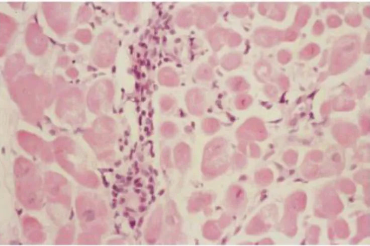 Figura  7:  Biopsia  endomiocárdica  que  muestra  rechazo  celular  con  infiltrado  inflamatorio  compuesto  de  linfocitos,  sin  daño  miocárdico