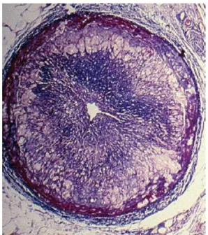Figura  9:  Enfermedad  vascular  del  injerto. 