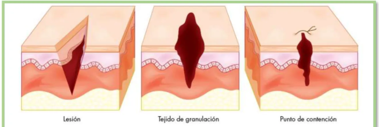 Figura 5-1: Cicatrización por tercera intención 