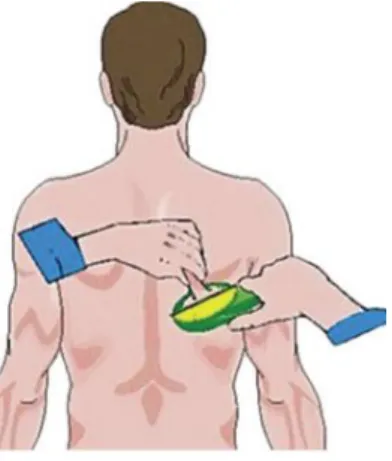 Figura 4. Pliegue subescapular