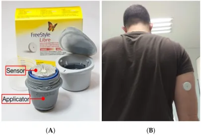 Figure 2. Abbott’s Freestyle Libre sensor and applicator (A), and adhered sensor (B).