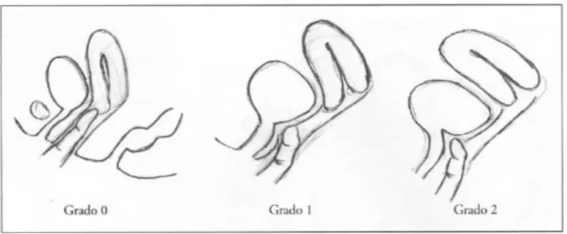 Fig. 5. Grados 0, 1 y 2 del test anterior. Según D. Grosse.  