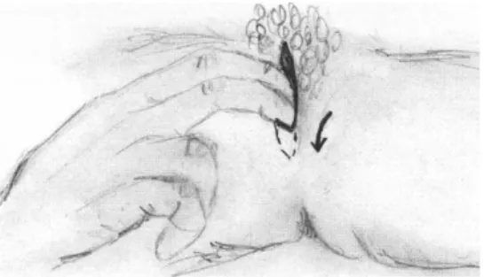Fig. 3. Palpación del tono perineal 