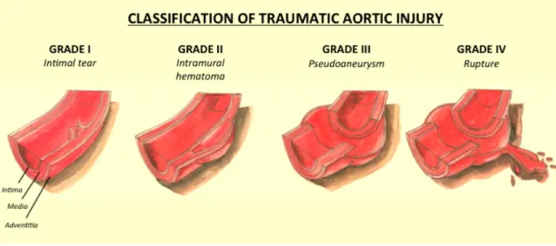 Figure 5. Classification of traumatic aortic injuries proposed by Azizzadeh et al.  33 
