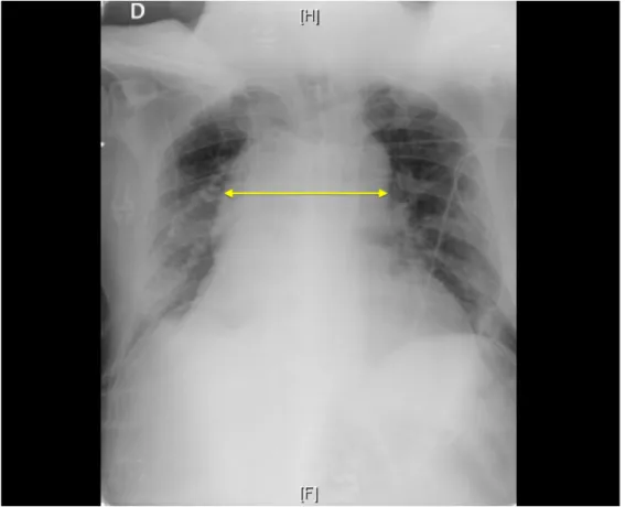 Figure  6.  Findings  of  ATAI  on  admission  CXR  I.  Supine  anteroposterior  CXR  following MVC shows widening of the mediastinum (arrow)
