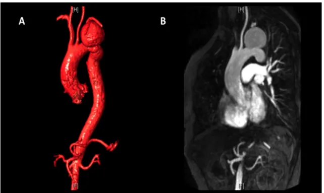 Figure 10. MRI in ATAIs. Control MRI of a saccular post-traumatic pseudoaneurysm  in a 51-year-old female 6 years after a fall