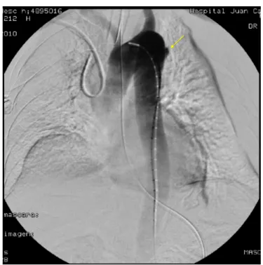Figure  12.  Aortography  (II).    Emergent  aortography  reveals  a  focal  outpunching 