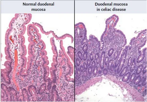 Figura 1. Mucosa intestinal normal y mucosa intestinal en EC. Tomado de Green &amp; Cellier, 2007