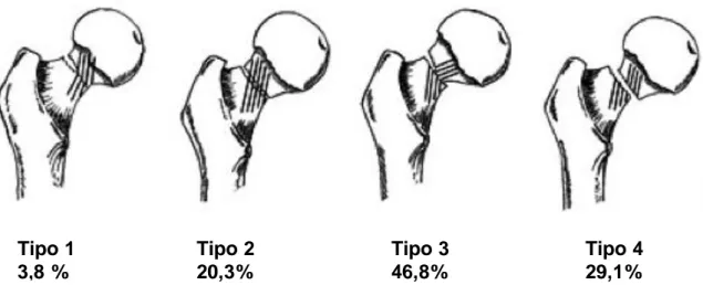 Figura 25: Distribución de pacientes con fracturas intracapsulares según la clasificación de Garden