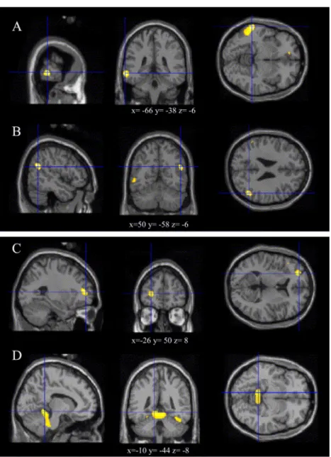 Fig. 1. Location of areas of the brain where there was significant abnormal glucose uptake in Parkinson's disease patients compared  to normal subjects