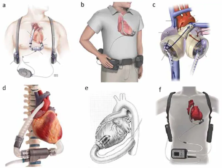 Figura 6. Representación esquemática de los dispositivos de asistencia ventricular de larga duración: a