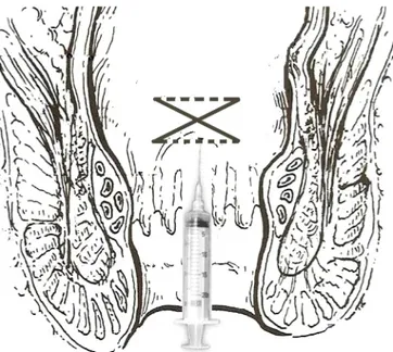 Figure 1. Mucosa suspension procedure