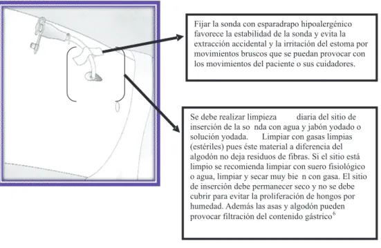 Figura 1.  Sonda de gastrostomía.