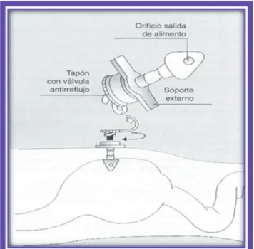 Figura 2. Botón de gastrostomía.