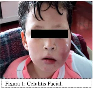 Figura 1: Celulitis Facial, 