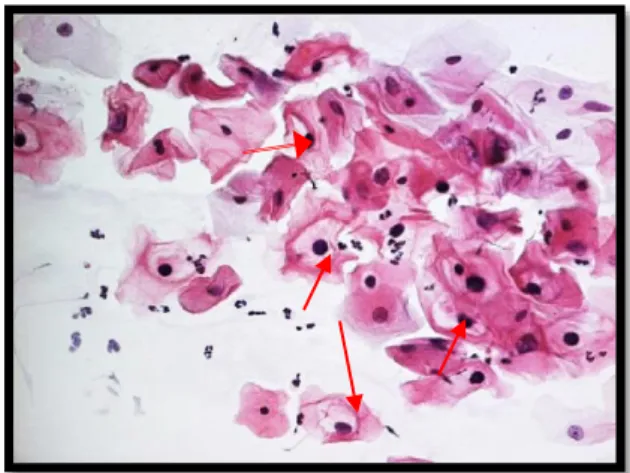 Figura 16-1 Coilocito (Flechas) signo   patognomónico de la infección por VPH 