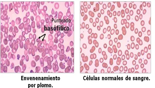 Figura 2.  Comparación entre células con punteado basófilico debido a la  presencia de plomo y células normales de sangre