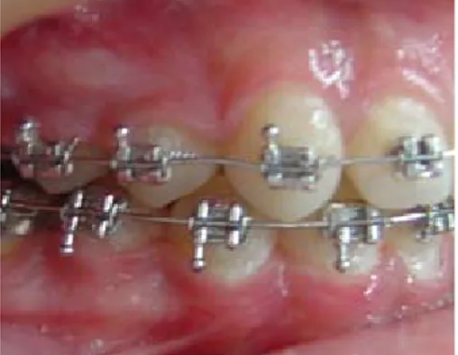 Figura 2 : Aparatología fija y acumulación de  placa en brackets.