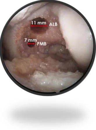 Figura	4:	Imagen	artroscópica	(portal	anterolateral)	de	una	rodilla	izquierda	que	 representa	 el	 posicionamiento	 de	 los	 túneles	 femorales.	 Debe	 existir	 un	 puente	 óseo	 de	 al	 menos	 2	 mm	 entre	 los	 dos	 túneles	 para	 evitar	 la	 convergenci