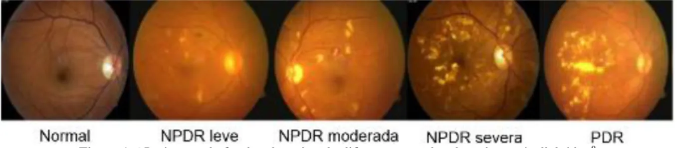 Figura 1.6 Imágenes de fondos de retina de diferentes estados de retinopatía diabética 8