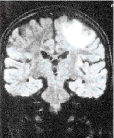 Foto 1. Nodulo hiperdenso sin edema perilesional que no cambia con el medio de contraste.