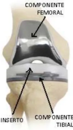 Figura 1. Fotografía de una prótesis total de rodilla con sus tres  componentes: componente femoral, inserto y platillo tibial.