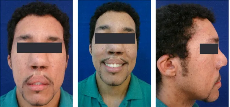 Figura 11. Fotos faciales posterior a retiro de aparatología ortodóncica.