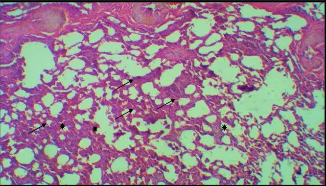Figura N° 5. Corte histológico de pulmón de Rattus norvegicus var. Sprague Dawley  en  la  que  se  observa  alteraciones  histológicas  con  exposición  de  30  minutos  a  emisiones  de  cigarrillo,  con  engrosamiento  de  la  membrana  alveolo  capilar