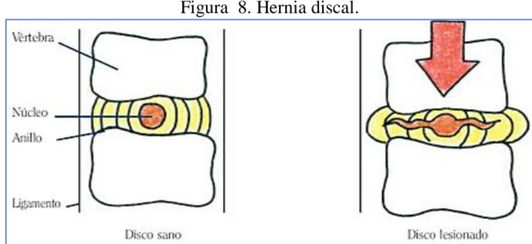 Figura  8. Hernia discal. 