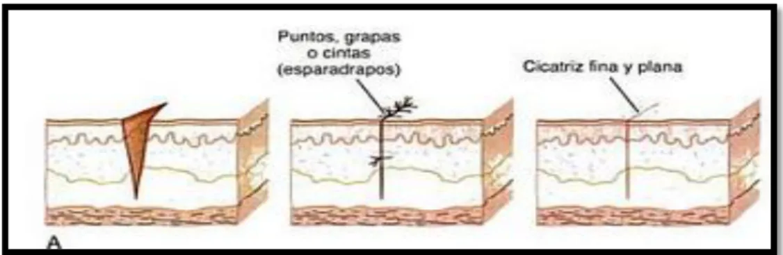 Figura 1-1: Proceso que requiere este proceso de cicatrización  