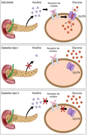 Figura No. 2-1.  Tipos de diabetes 