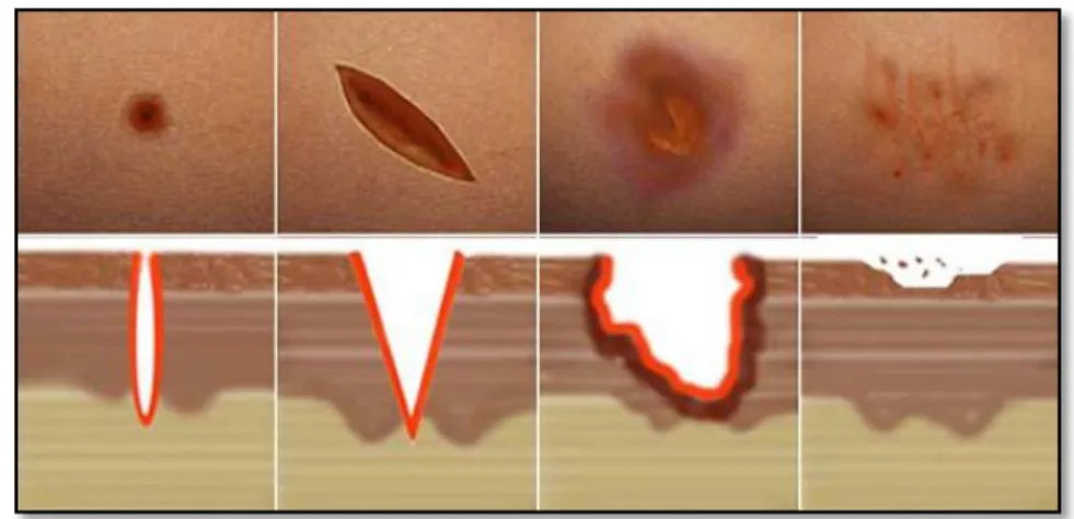 FIGURA No. 5 TIPOS DE HERIDAS 