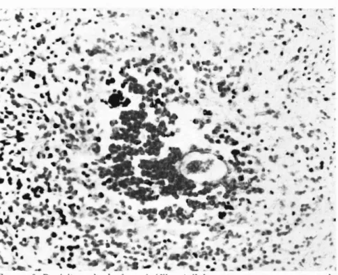 Figura 6. Parásito rodeado de eosinófilos (células que aparecen oscuras y de