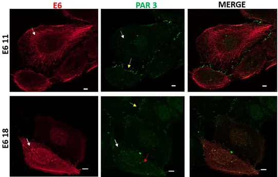 Figura 4.5: Efecto de la proteína E6 de  VPH sobre la distribución de PAR 3 en células epiteliales