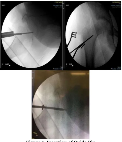 Figure 2. Insertion of Guide Pin 