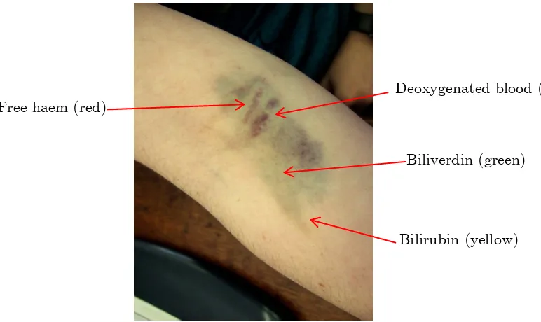 Figure 1-8: Bruising is an example of endogenous CO production.
