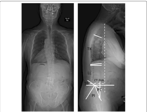 Fig. 1 Standing-erect whole-spine posteroanterior and lateral full-spine radiographs. Measurement of sagittal parameters